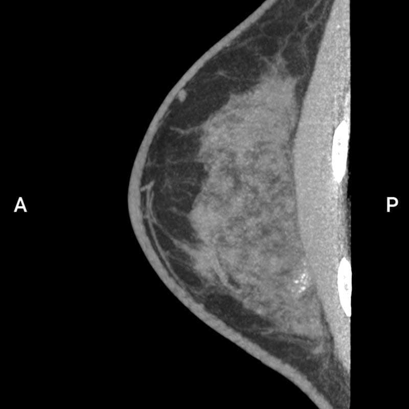 疑わしい局所性微小石灰化（BI-RADS 4）画像