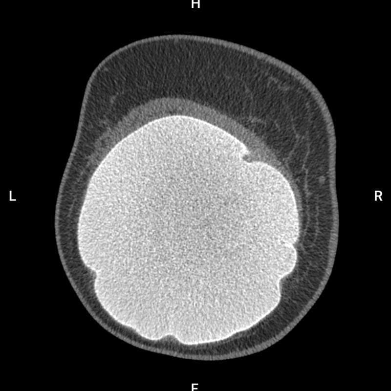 疑わしい局所性微小石灰化（BI-RADS 4）画像