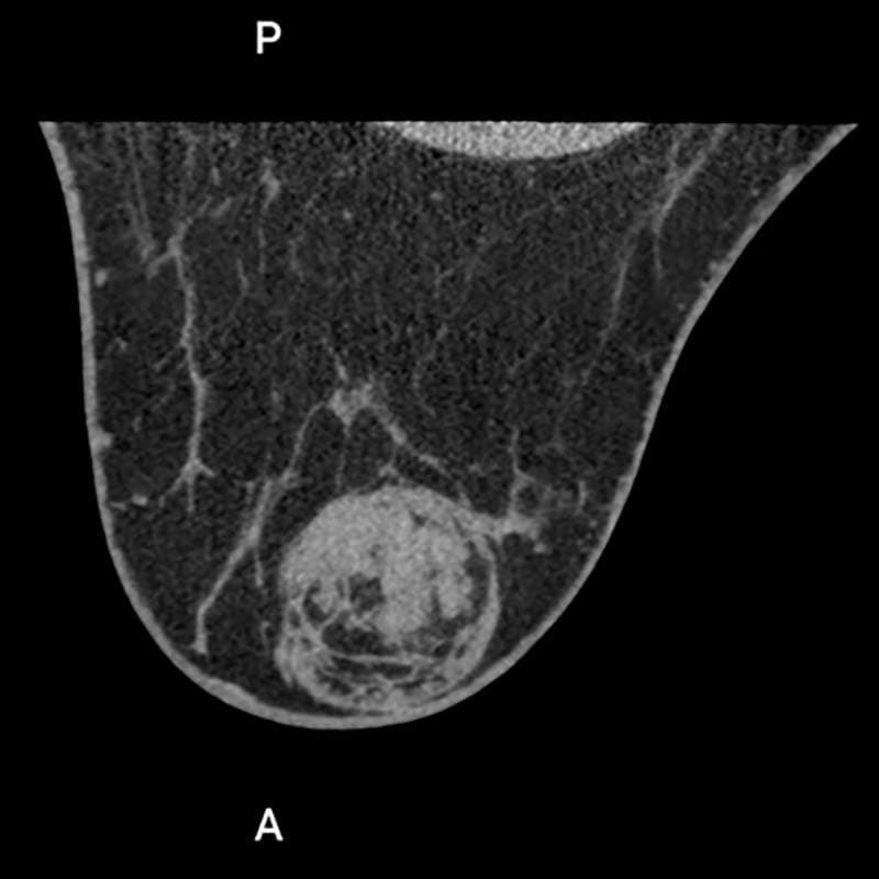 触知可能な腫瘤（BI-RADS 2）画像